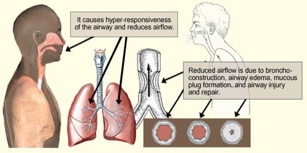 COPD